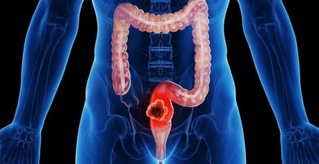 anal-cancer