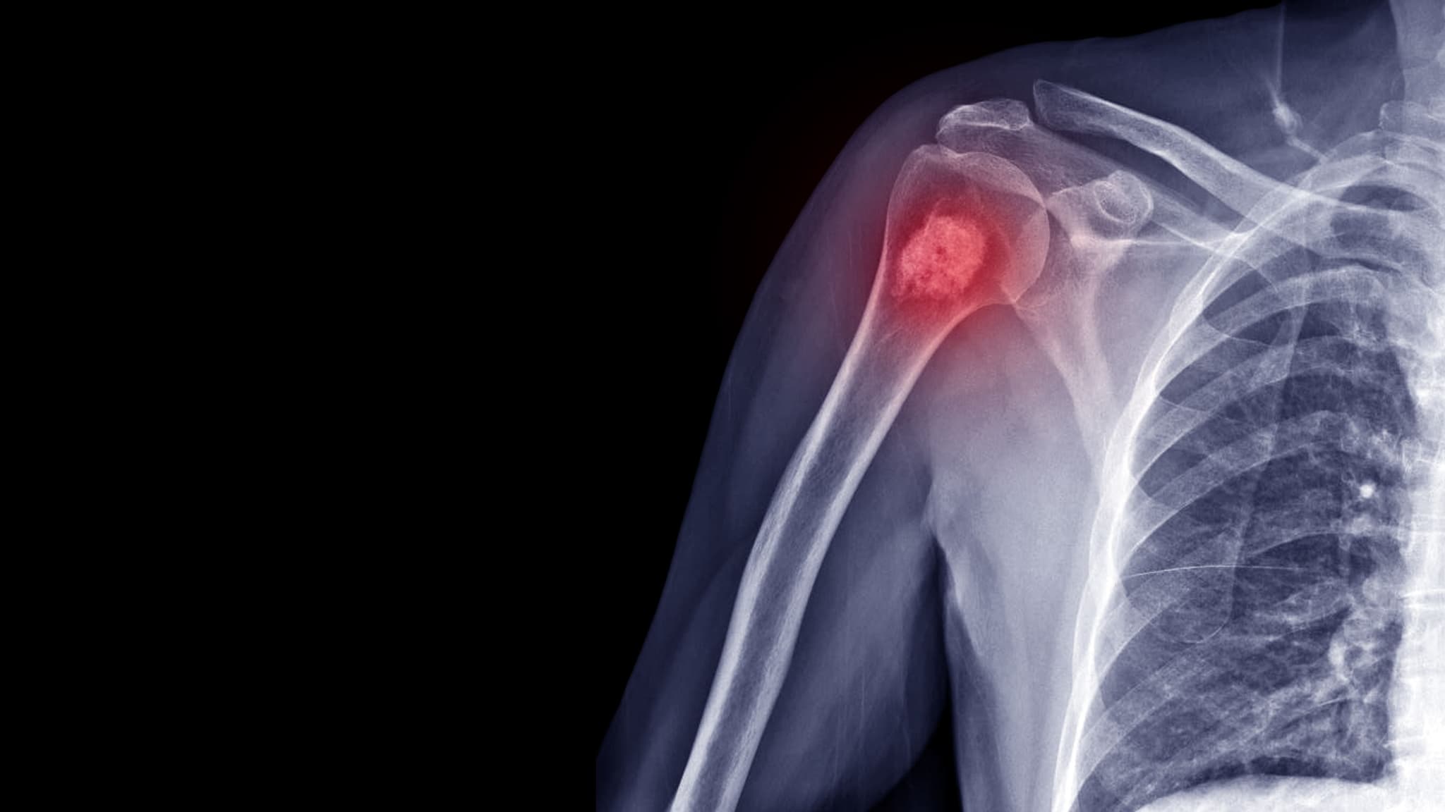 bone-cancer