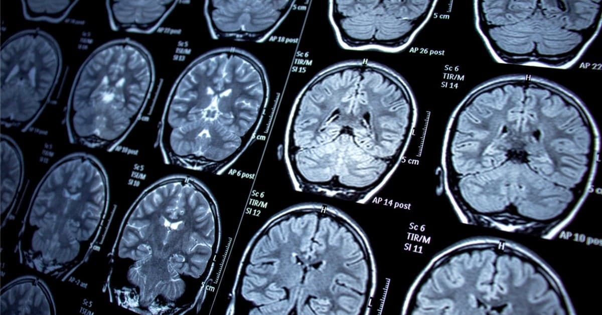 brain-cancer