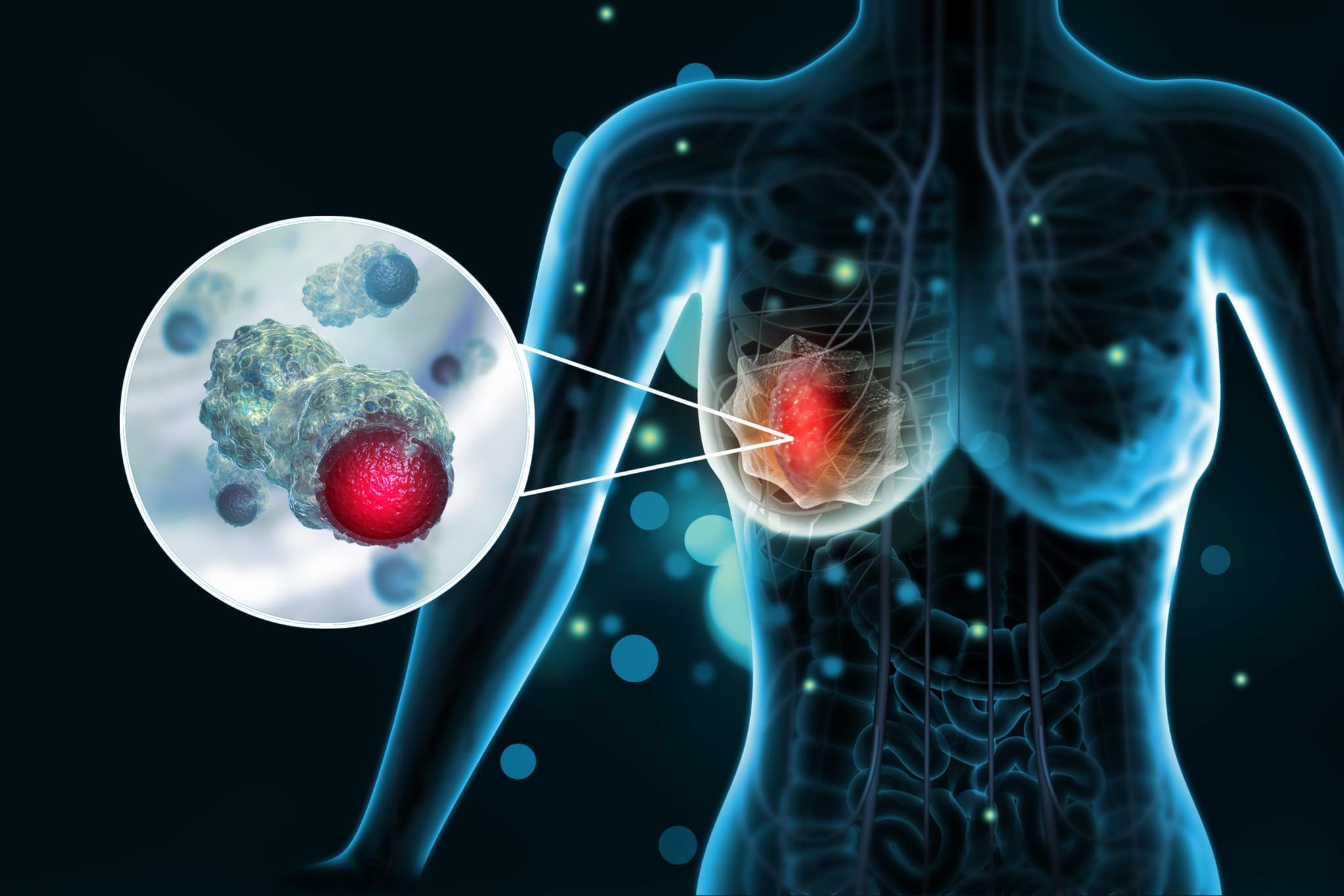 breast-cancer