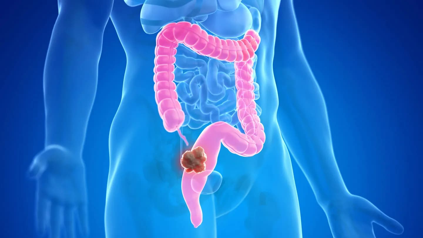 colorectal-cancer
