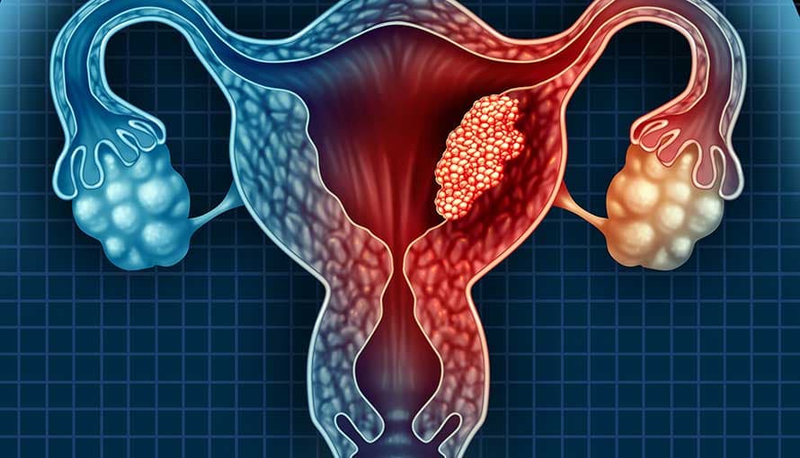 endometrial-cancer