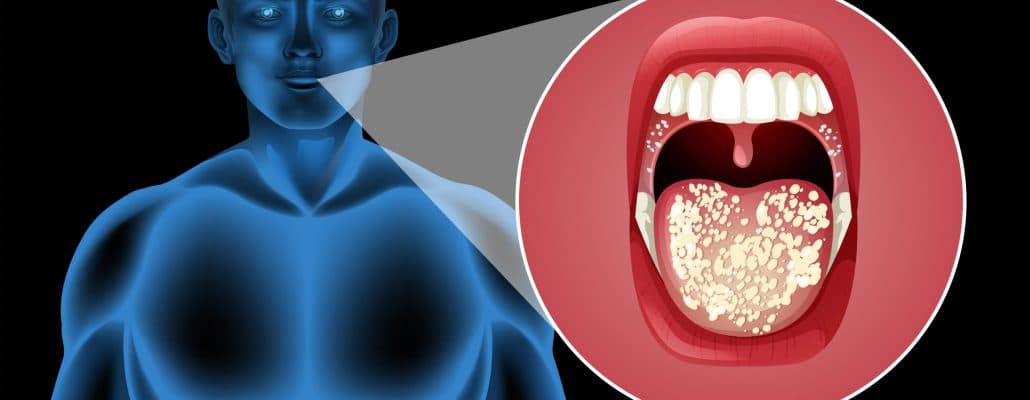 mouth-and-oral-cancer